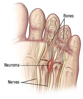 Neuroma steroid injection