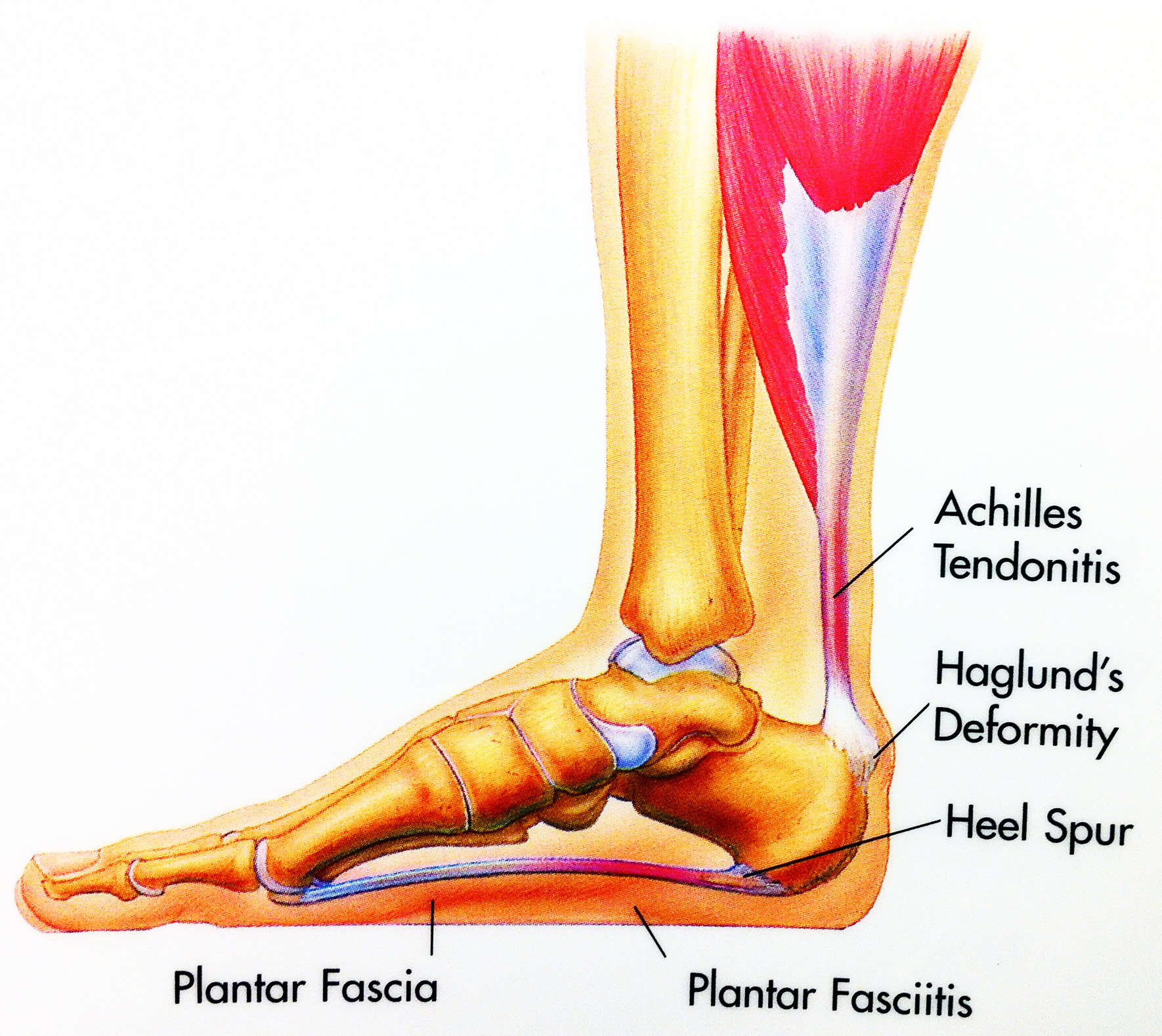 plantar calcaneal spur images