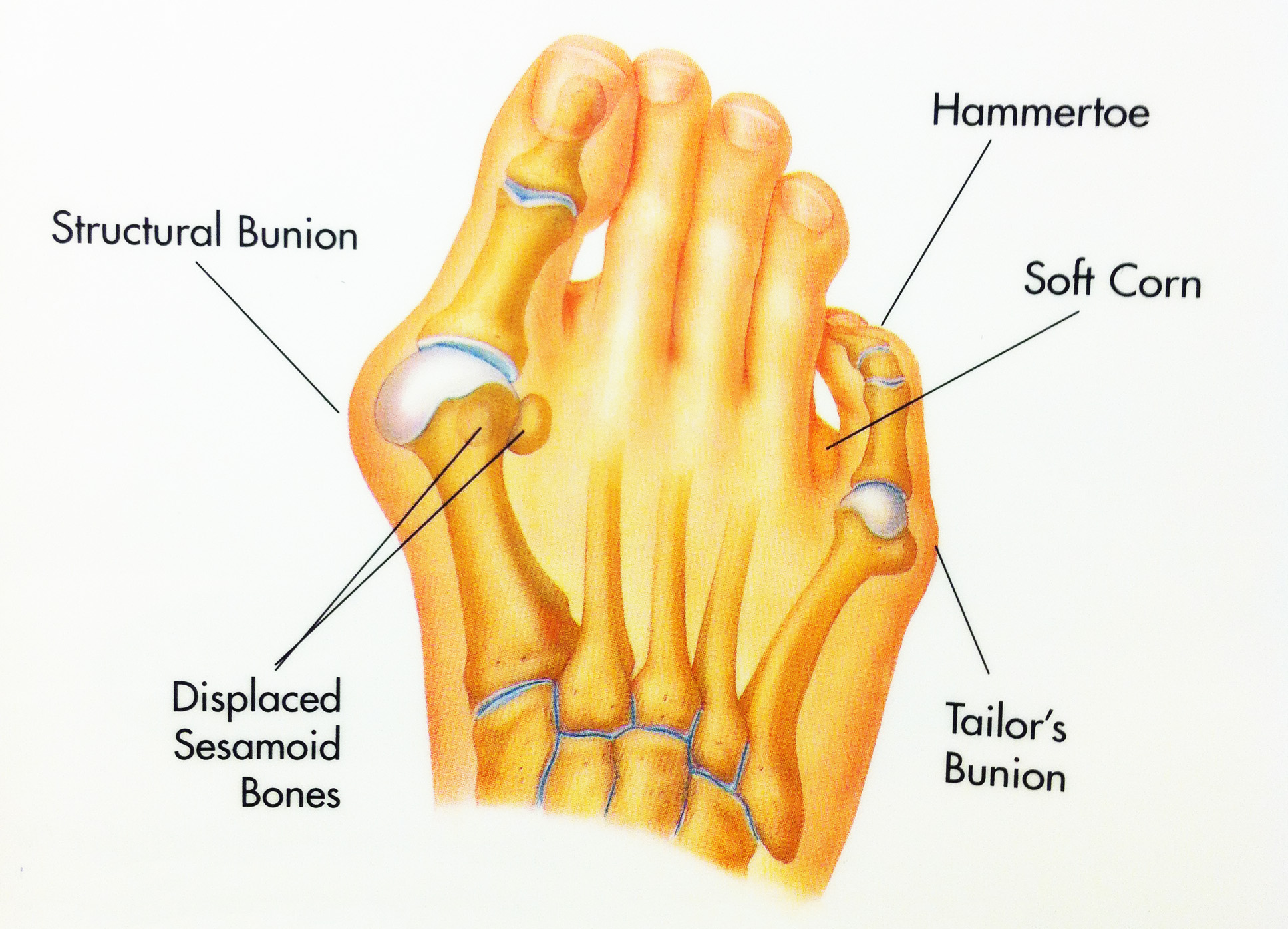 Hammertoe