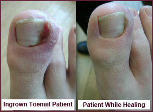 Ingrown Toenail (Onychocryptosis): Symptoms & Treatment